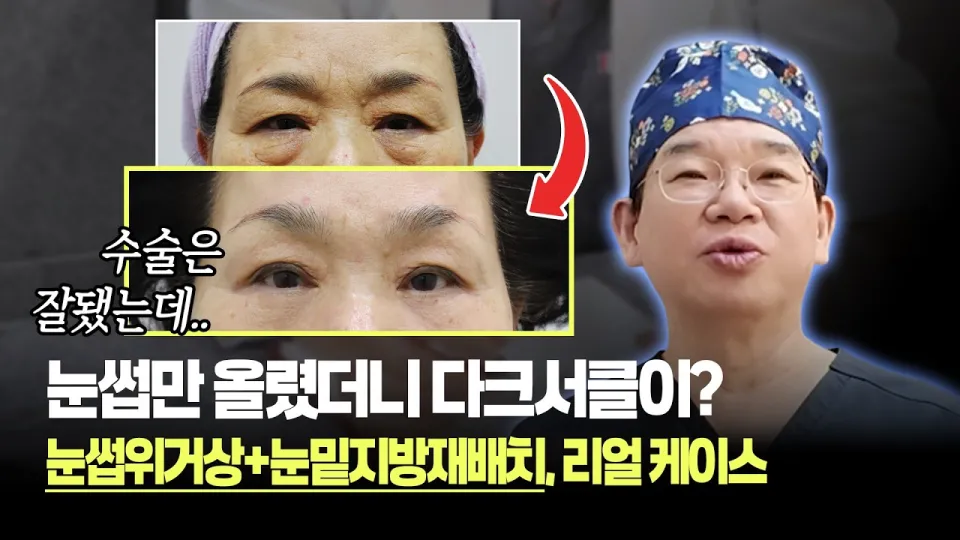 눈썹위거상 수술 후 1년까지의 변화와 후회 없는 선택 방법