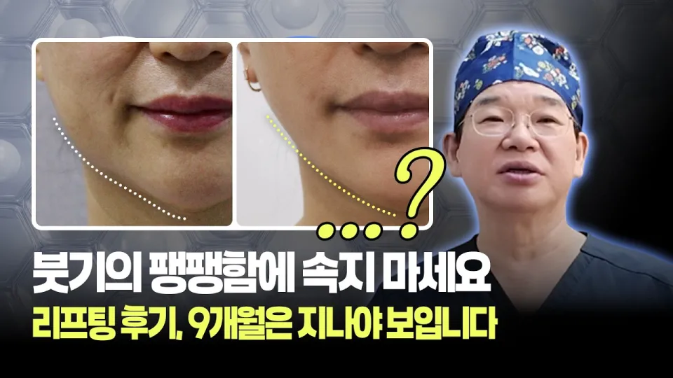 리프팅시술, 9개월 후 진짜 라인과 효과 분석